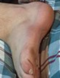 Caden's foot.png