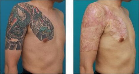 Surgical-Excision-of-a-Tattoo.jpg