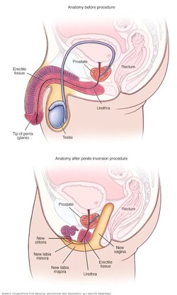 penile-inversion-8col.jpg