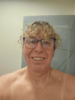 01week-and-half-after-ffs-surgery-i-mexico-city-with-dr-v0-wxhstx8109xc1.jpg