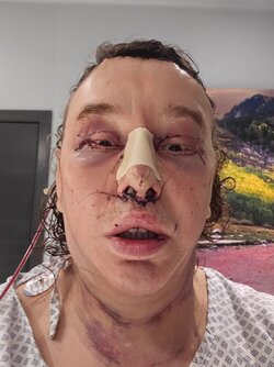 02week-and-half-after-ffs-surgery-i-mexico-city-with-dr-v0-nuiqycc109xc1-min.jpg