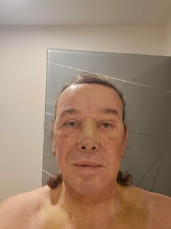 03week-and-half-after-ffs-surgery-i-mexico-city-with-dr-v0-aop2dxe109xc1-min.jpg