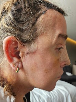 04week-and-half-after-ffs-surgery-i-mexico-city-with-dr-v0-nti6vui109xc1-min.jpg