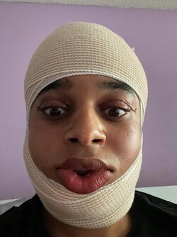 05ffs-with-hadeed-10hrs-post-op-v0-fyyrzv4m7twc1.jpg