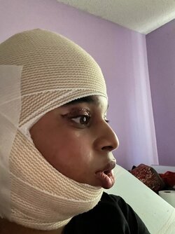 06ffs-with-hadeed-10hrs-post-op-v0-hq80aw4m7twc1-min.jpg