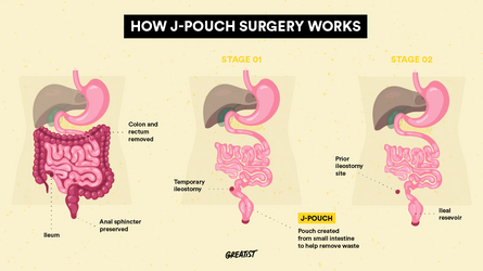 496405-JPouch-Surgery-Body-1296x728-1[1].png