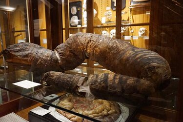 170904-mutter-museum-philadelphia-skulls-medical-exhibitions-7[1].jpg