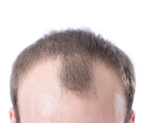 receding-hairline-parker-trichology-.png