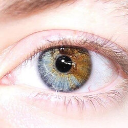 sectoral-heterochromia-eye.jpg