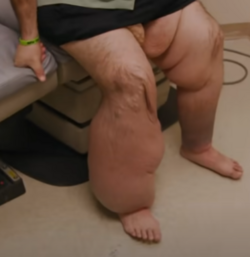 lymph legs.PNG