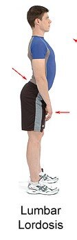 lordosis.jpg
