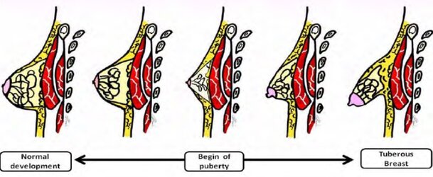 breast2.jpg