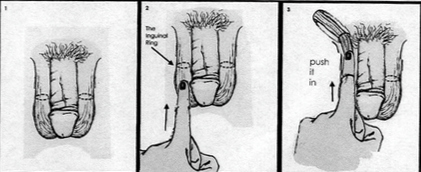 ah yes inguinal canal one of ww2s most decisive battles.png