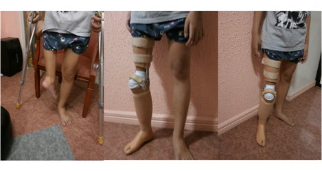 Rotationplasty+Prosthesis-4185699739.png