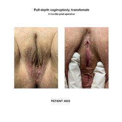 4002_full-depth-vaginoplasty_2photos.jpg