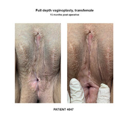 4047_full-depth-vaginoplasty.jpg