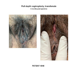 4048_full-depth-vaginoplasty.jpg