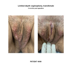 4049_limited-depth-vaginoplasty.jpg