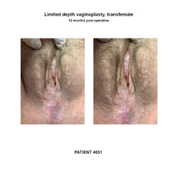 4051_limited-depth-vaginoplasty.jpg