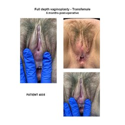 4005_transfemale-full-depth-vaginoplasty.jpg