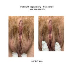 4009_transfemale-full-depth-vaginoplasty.jpg