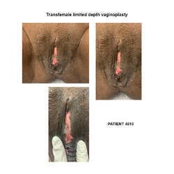 4010_transfemale-limited-depth-vaginoplasty.jpg