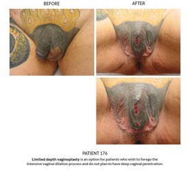 176_Limited-Depth-Vaginoplasty-1.jpg
