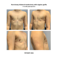 4032_non-binary-mastectomy.jpg