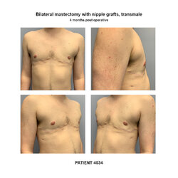 4034_bilateral-mastectomy-transmale.jpg
