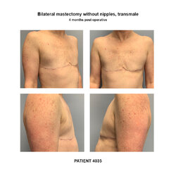 4035_bilateral-mastectomy-transmale.jpg