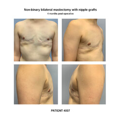 4037_non-binary-bilateral-mastectomy.jpg