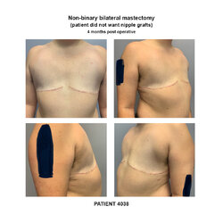 4038_non-binary-bilateral-mastectomy.jpg