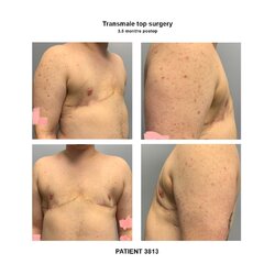 3813_transmale-top-surgery.jpg