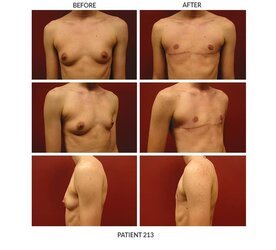 213_FTM-Chest-Surgery.jpg