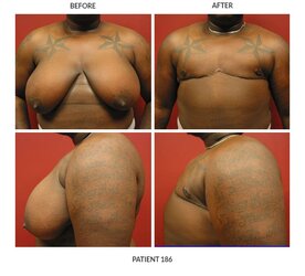 186_FTM-Chest-Surgery.jpg