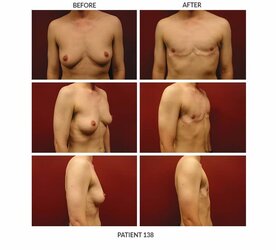 138_FTM-Chest-Surgery.jpg