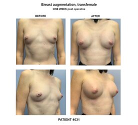 4031_breast-implants-transfemale-1-800x725_c.jpg