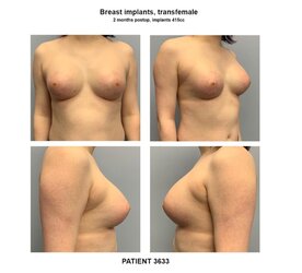3633_breast-implants-transfemale-800x725_c.jpg