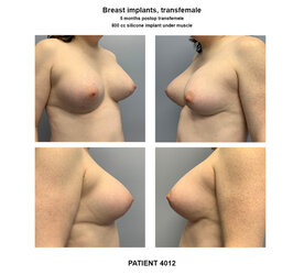 4012_breast-implants-transfemale-800x725_c.jpg