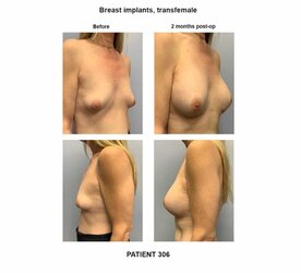 306_breast-implants-transfemale-800x725_c.jpg