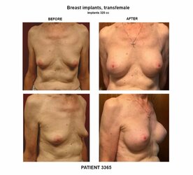 3365_breast-implants-transfemale-800x725_c.jpg