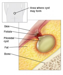 cyst.jpg
