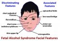 Fetal-Alcohol-Syndrome-Facial-Features.jpg