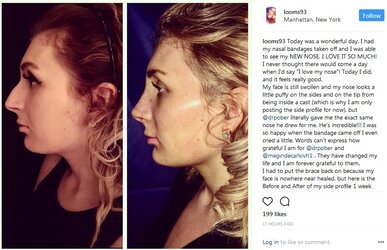 laura-loomer-nose-job8.jpg
