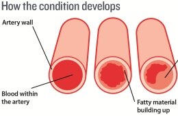 atherosclerosis2_illustration_260x170_hm_exp0516.jpg