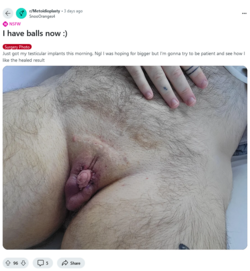 Screenshot 2024-09-30 at 11-56-06 I have balls now ) r_Metoidioplasty.png