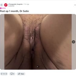 Screenshot 2024-10-03 at 00-03-03 Post op 1 month Dr Sutin r_Transgender_Surgeries.png