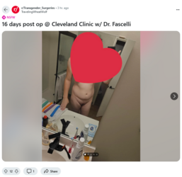 Screenshot 2024-10-05 at 18-13-18 16 days post op @ Cleveland Clinic w_ Dr. Fascelli r_Transge...png