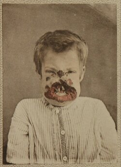 Syphilis_face_1.jpg