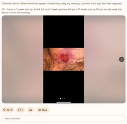 Multiple_fistulas2.jpg